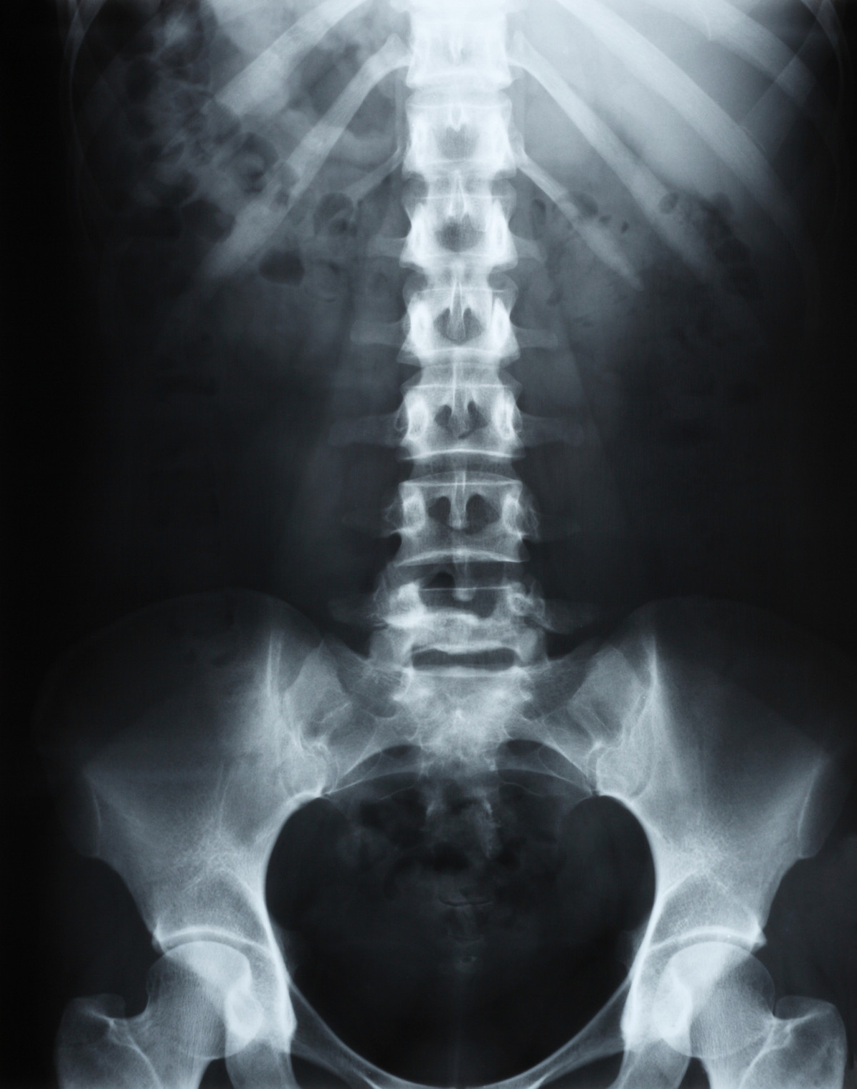 spine-xray-i-spine-institute-dr-jamie-gottlieb-indiana