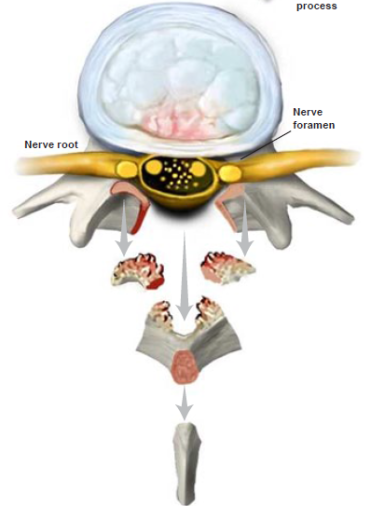 laminectomy